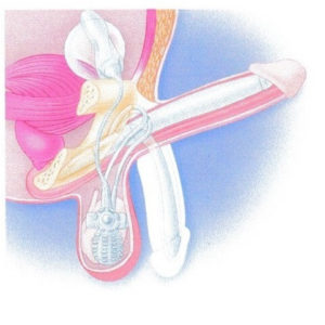 implant u penisu