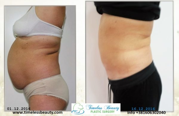 abdominoplastika i trbušna kila
