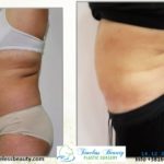 abdominoplastika i trbušna kila